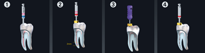 utilisation du Starter Kit Endo ReStart