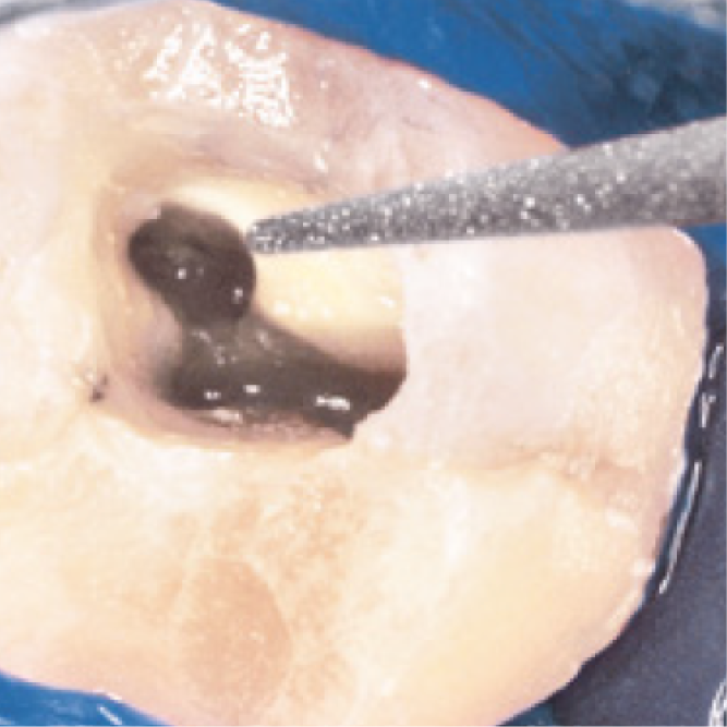 Inserts d’endodontie