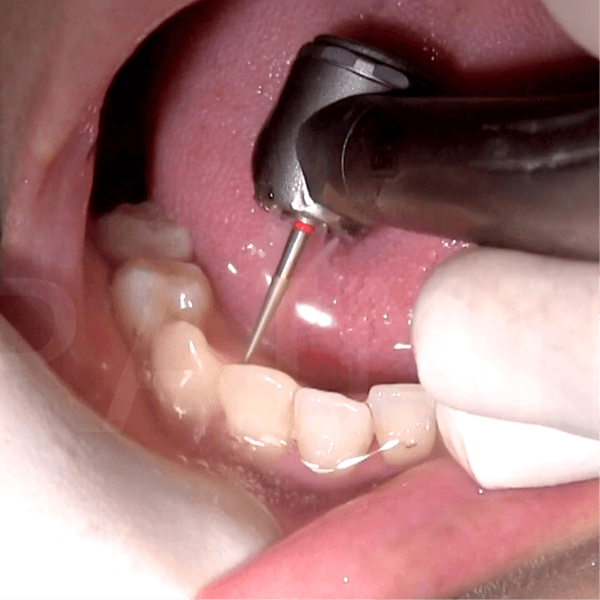 Aligners Kit