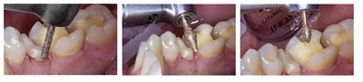 diao-dent.png